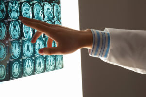 Brain Injury Lawyer Houston, TX- mri images of brain